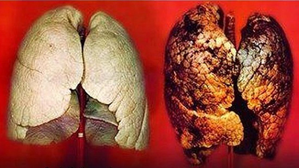 ung thư phổi, ung thư