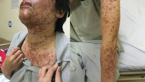 Nổi mẩn đỏ do dị ứng thuốc, bác sĩ cho uống thuốc sởi