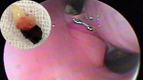 Kỳ lạ nữ sinh mọc răng ở lỗ mũi