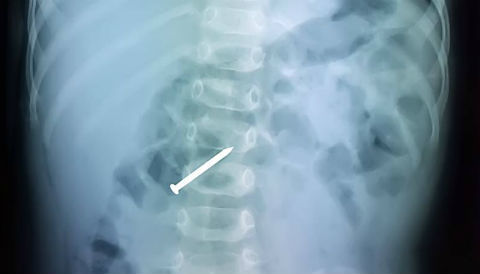 Bé trai suýt chết vì nuốt đinh dài 3cm vào bụng