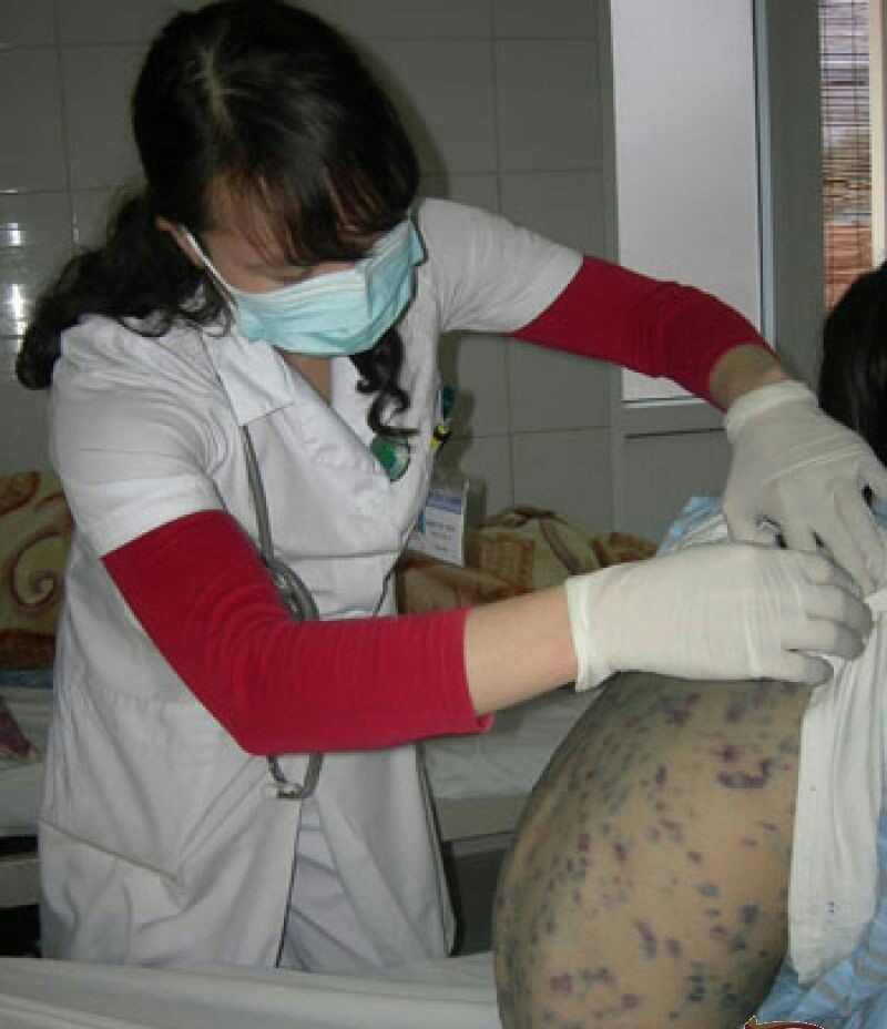 {title} thủy đậu,triệu chứng thủy đậu,cách chữa thủy đậu