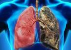 Dấu hiệu điển hình của ung thư phổi: Biết sớm để giành lại cơ hội sống cao nhất là 49%