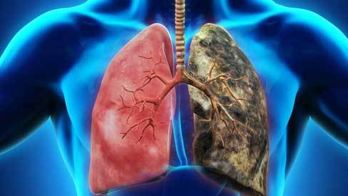 Dấu hiệu điển hình của ung thư phổi: Biết sớm để giành lại cơ hội sống cao nhất là 49%