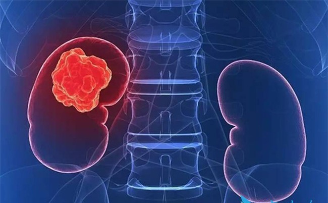 3 dấu hiệu điển hình bệnh ung thư thận: Nếu không can thiệp thì không sống được quá 1 năm