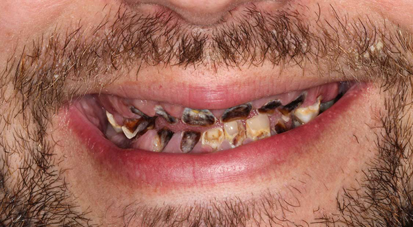 Hàm răng chàng trai thối rữa do nghiện loại đồ uống quen thuộc