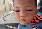 Bé trai 2 tuổi bị cha dượng đánh đập dã man