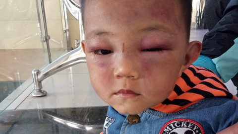 Bé trai 2 tuổi bị cha dượng đánh đập dã man