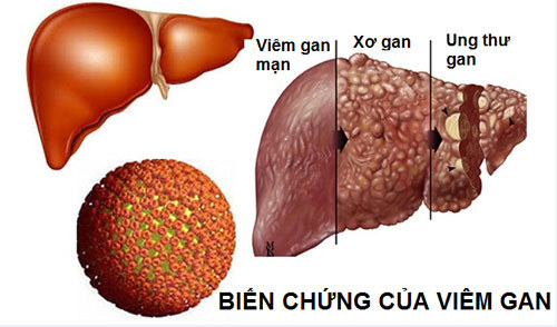 3 xét nghiệm đặc hiệu phát hiện sớm ung thư gan