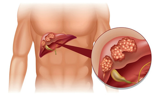 MEDLATEC ứng dụng công nghệ Nhật chẩn đoán sớm ung thư gan