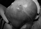 Đau bụng kéo dài, bóc ra khối u nặng bằng đứa trẻ 6 tháng
