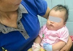 Ngủ trên võng, bé 2 tháng tuổi bị chó cắn phải nhập viện