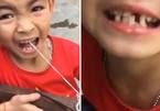 Clip cậu bé Việt Nam nhổ răng bằng nỏ lên báo Anh