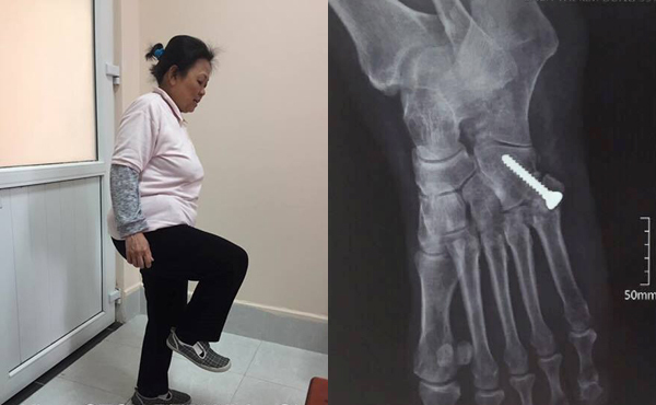 Khó tin, một phụ nữ Hà Nội uống hàng chục kg thuốc giảm đau