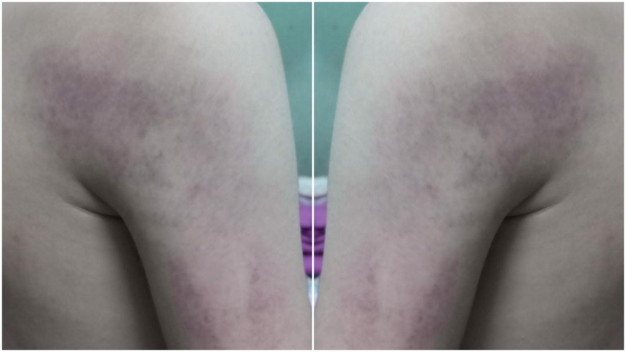 Cô giáo nhiều lần đánh học sinh lớp 1 bầm tay