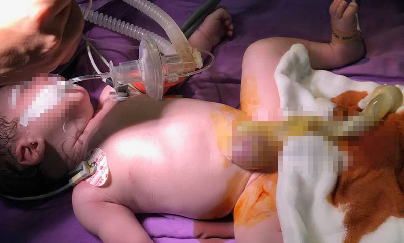 Vừa chào đời, bé sơ sinh lòi nội tạng ra ngoài