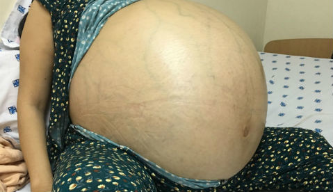 Mang khối u 50kg, bụng người phụ nữ trương phình muốn nổ tung