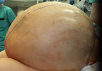 Ca cực hiếm: Người phụ nữ mang khối u buồng trứng 60kg