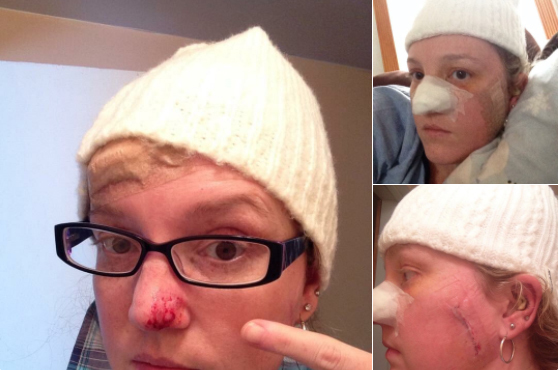 Khó tin: 42 tuổi phẫu thuật tới 86 lần vì ung thư da