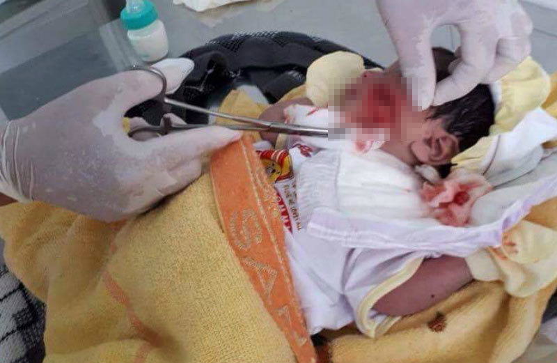 Bé trai sơ sinh ở Bình Thuận bị chôn sống, phải khâu 10 mũi ở mặt