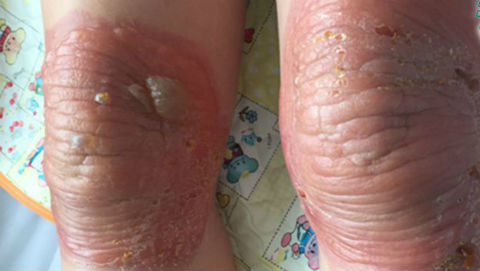 Đau đầu gối, suýt phải cắt bỏ khi tới thầy lang đắp thuốc nam