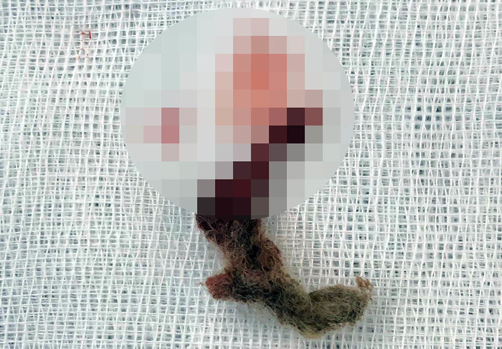 Bé gái đau đớn suốt 2 tháng vì dị vật trong âm đạo