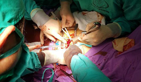 Té ngã vào dao vợ cầm gọt trái cây, chồng bị đâm thủng tim