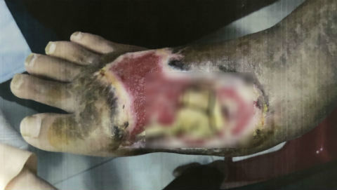 Bé gái bị rắn độc cắn, lòi xương bàn chân ra ngoài