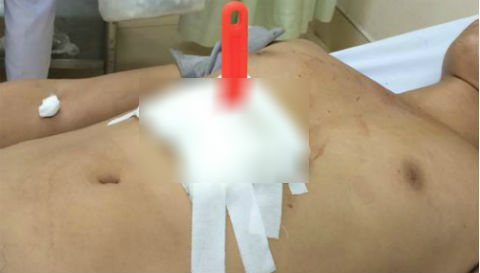 Bác sĩ xuyên đêm cứu thanh niên bị đâm thấu ngực, rách màng tim