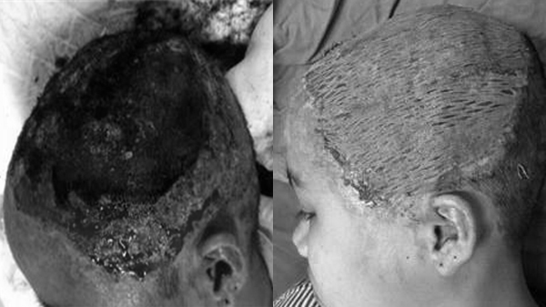 Thiếu nữ 17 tuổi lột hết da dầu sau uốn tóc mừng sinh nhật