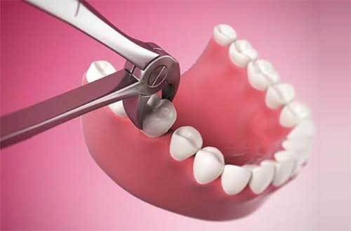 Phòng nỗi lo bỗng nhiên… mất răng