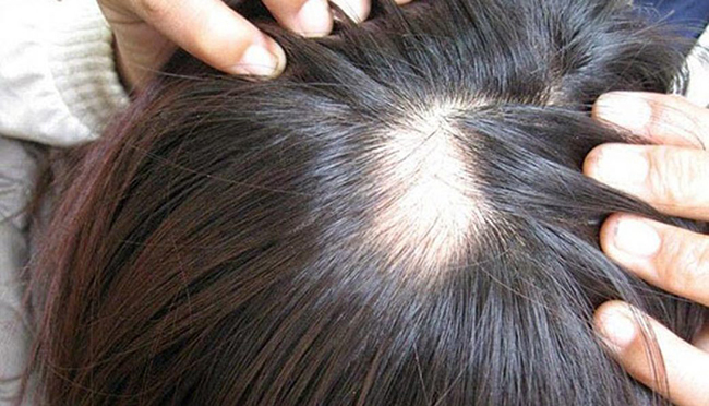 Rụng tóc mảng Nguyên nhân triệu chứng và điều trị  Medlatec