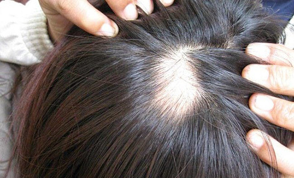 05 cây thuốc nam điều trị rụng tóc theo kinh nghiệm dân gian
