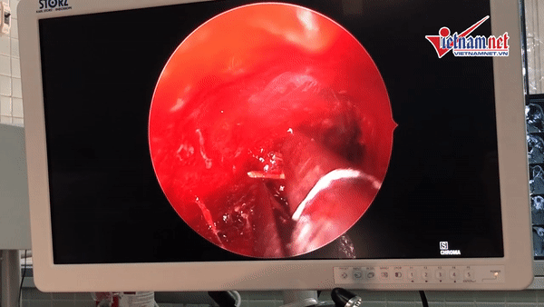Xem video bác sĩ gắp 10 mảnh cây ghim vào hốc mắt người bệnh