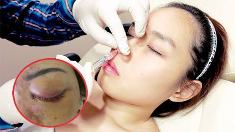 TPHCM: Kinh hãi cô gái mù mắt sau 5 phút tiêm filler ở spa