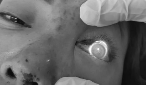 Cô gái mù mắt khi tiêm filler: Spa dính nhiều sai phạm