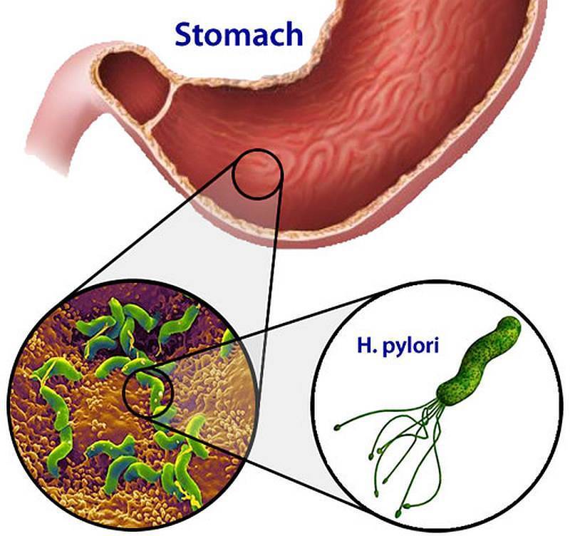 Vi khuẩn Helicobacter pylori (HP) khiến chàng trai bị hôi miệng nặng