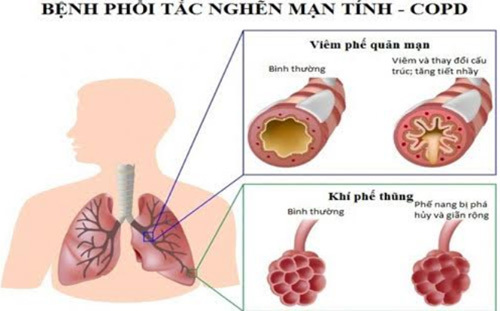 Làm gì khi bị phổi tắc nghẽn mãn tính?