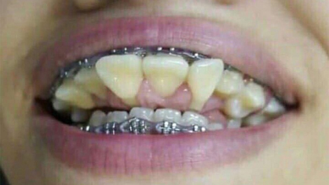 Sự thật hàm răng chỉa ngược của cô gái khiến nhiều người phát hoảng