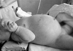 Bé gái 6 tháng bụng phình như trái bóng vì mang bào thai từ trong bụng mẹ