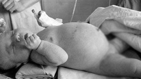 Bé gái 6 tháng bụng phình như trái bóng vì mang bào thai từ trong bụng mẹ