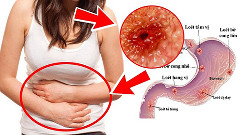 5 biến chứng nguy hiểm của bệnh lý dạ dày