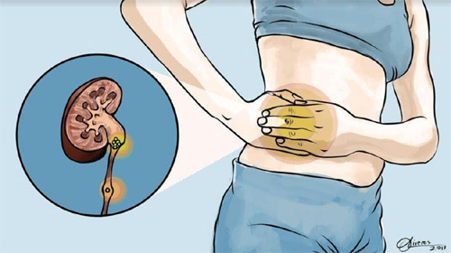 7 dấu hiệu cảnh báo bệnh sỏi thận