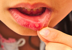 Dấu hiệu ung thư miệng không nên bỏ qua, nhất định phải đi khám
