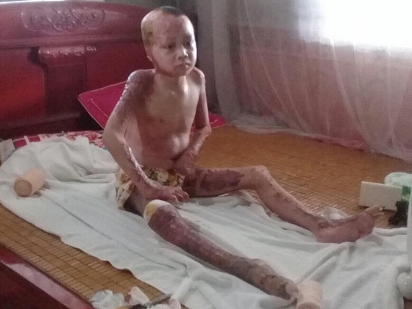 Em Nguyễn Văn Đồng bị bỏng nặng đã được xuất viện