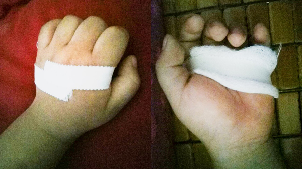 Cha mẹ lưu ý, ngón tay con bị cong cần nghĩ tới bệnh này