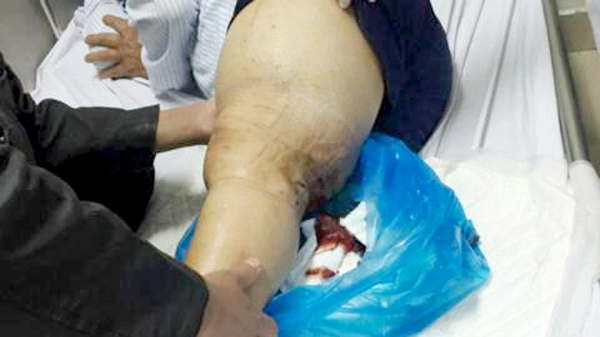 ‘Căn bệnh hoàng gia’ khiến cụ ông chảy máu không ngừng