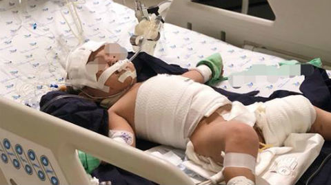 Bé 20 tháng bị bỏng nguy kịch vì vật dụng nhà nào cũng có
