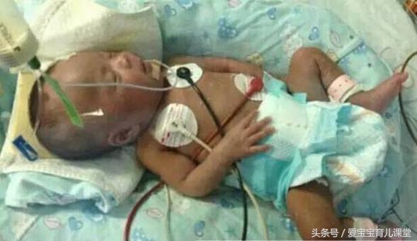 Cậu bé 10 ngày tuổi bị nhiễm trùng máu nặng vì mẹ sơ ý bứt cuống rốn