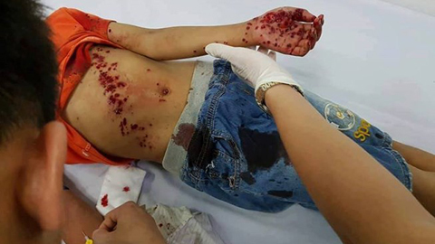 Pin đồ chơi phát nổ, bé trai nhoe nhoét vết thương