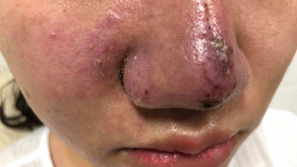 Hà Nội: Thiếu nữ suýt mất mũi, lệch mặt vì làm đẹp